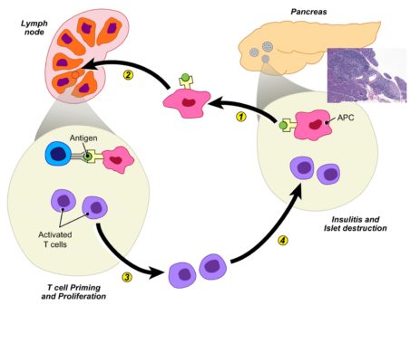 Type 1 Diabetes Pathology